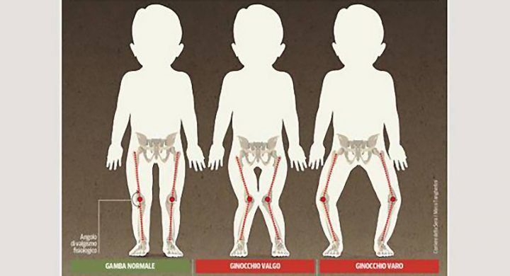 Correzione del Ginocchio Valgo o Varo