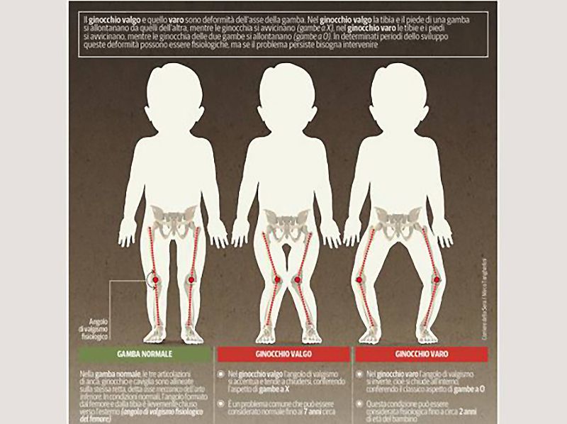 Correzione del Ginocchio Valgo o Varo