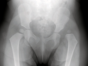 DDH Congenital Hip Dysplasia Pre Op Scan