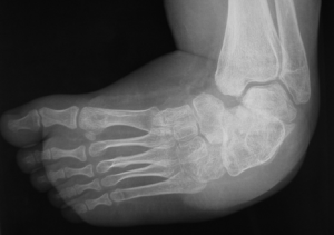 Clubfoot x-ray Pre-op