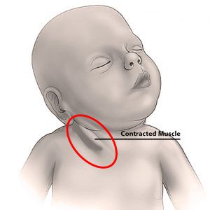 Congenital Muscular Torticollis Picture