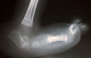 Congenital Vertical Talus X Rays Prof Portinaro Foot Reconstruction