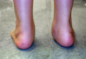 Flat Feet Detail Back prof. Portinaro