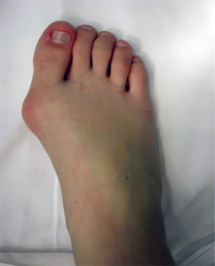 Alluce valgo bambini