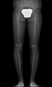 Dismetria Radiografia Post-Op