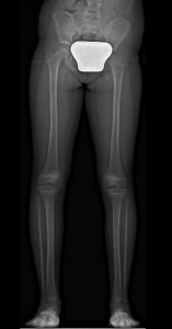 Dismetria Radiografia Pre-op