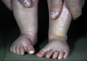 Metatarsus Adductus Diagnosis Prof. Nicola Portinaro