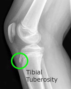 Morbo di Osgood Schlatter Radiografia Tuberosità Portinaro