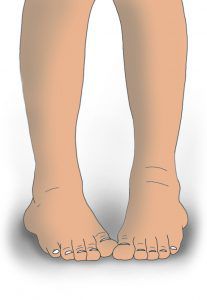 Pigeon Toed Feet
