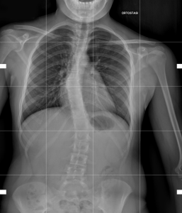 Radiografia Scoliosi