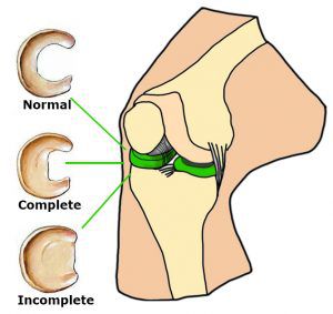 Immagine Menisco Discoide