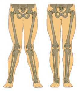 knock knees vs normal knees image