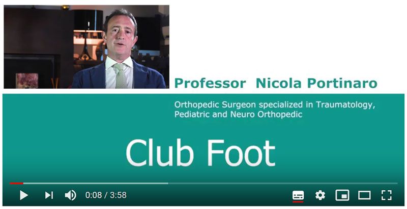 Piede Torto Congenito Video YouTube Portinaro
