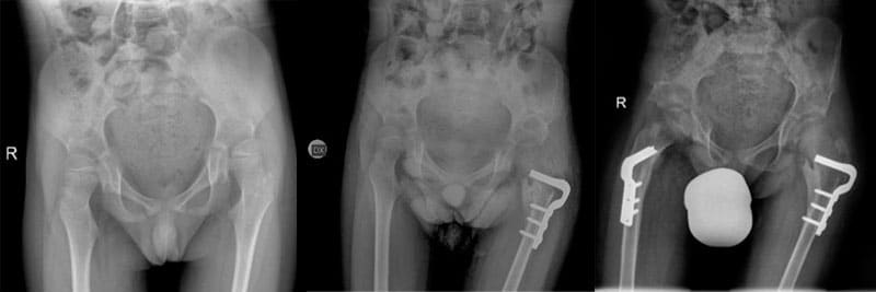 ricostruzione completa anca portinaro paralisi cerebrale