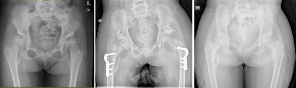 Pelvic and femoral osteotomy
