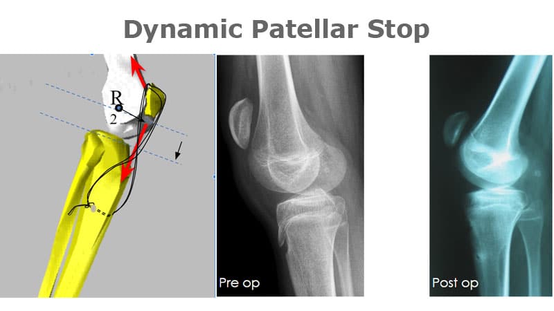 Dynamic Patellar Stop Nicola Portinaro