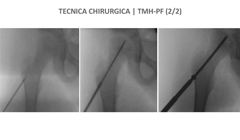 Emiepifisiodesi Temporale Mediale del Femore Prossimale (TMH-PF) tecnica chirurgica