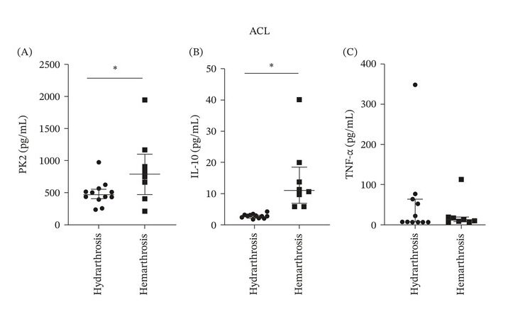 Grafici dei livelli di procineticina-2, IL-10 e TNF-α con emartro e con idrarto, in pazienti con lesione isolata del crociato anteriore